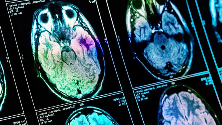 Röntgenaufnahme des Gehirns